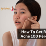 How To Get Rid Of Acne 100 Percent?